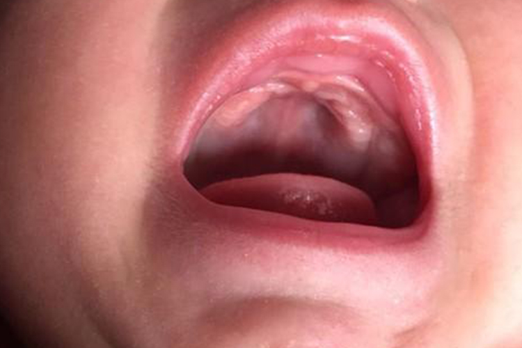 新生儿高腭弓图