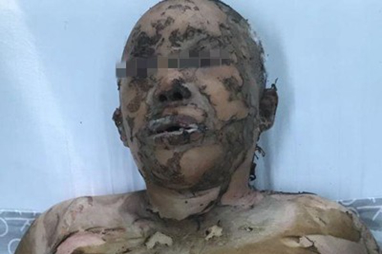 电烧伤面部脱皮发黑图 电烧伤面部脱皮发黑图