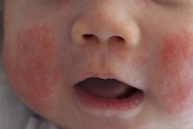 奶癣脸颊局部发红有鳞屑图