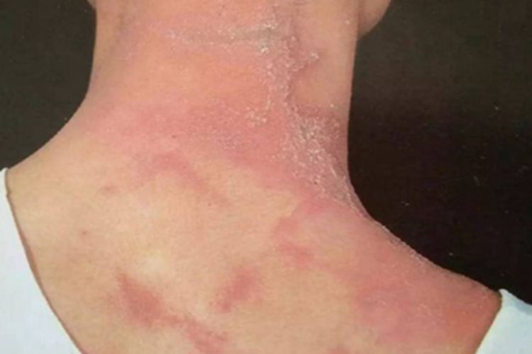 隐翅虫皮炎后颈脱屑图