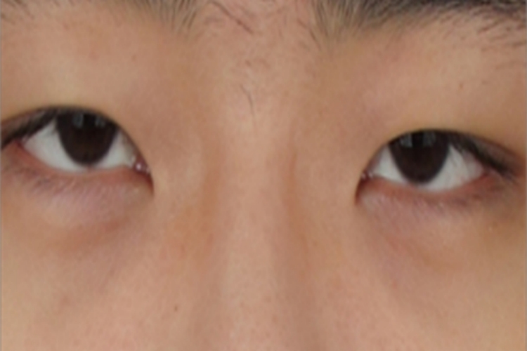 内眦赘皮内上眼皮下垂图 内眦赘皮内上眼皮下垂图