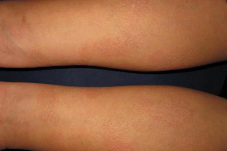 干性湿疹胳膊皮肤粗糙图 干性湿疹胳膊皮肤粗糙图