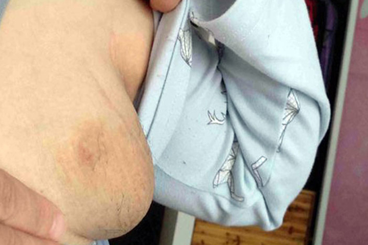 女性腋窝下正常副乳图