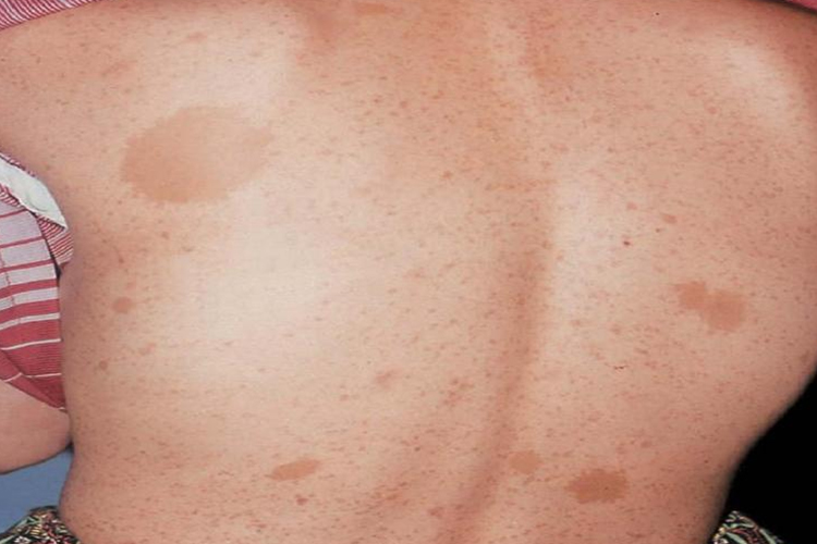 咖啡斑后背散在大面积斑片图
