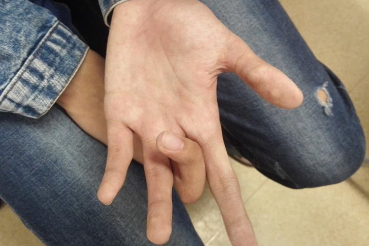 外伤导致畸形手指图 外伤导致畸形手指图