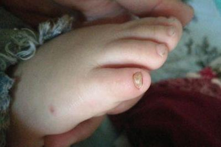 婴儿初期甲癣趾甲黄褐色图