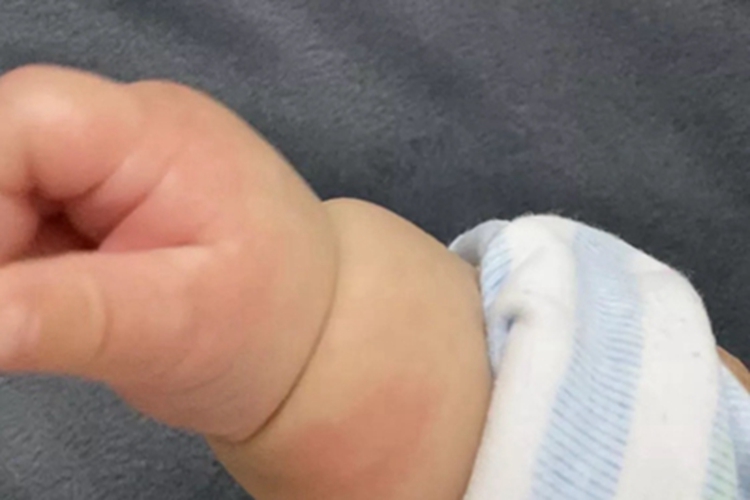 皮肤过敏红肿手部红肿图