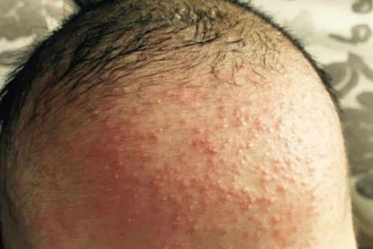 额头湿疹图