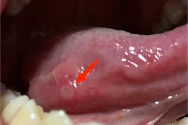 轻型阿弗他溃疡舌侧症状图