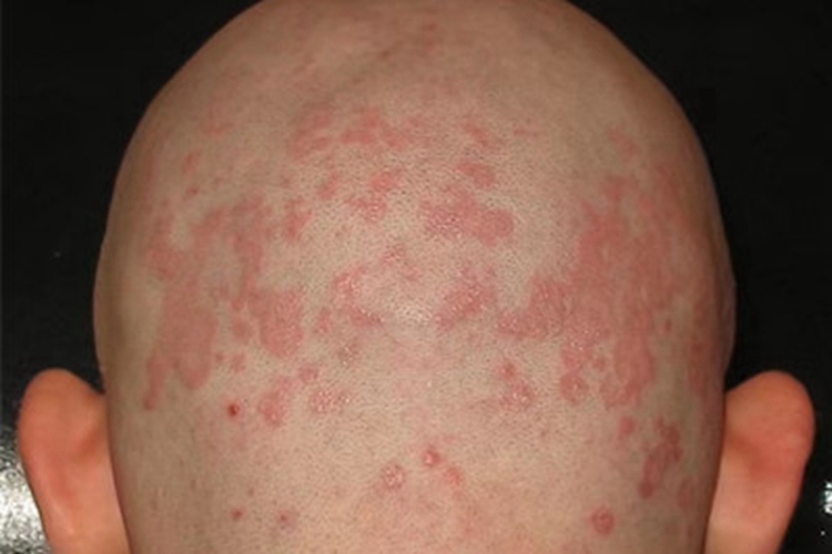 成人脂溢性皮炎头皮红斑图