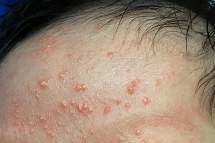 新生儿痤疮前额上长脓包图