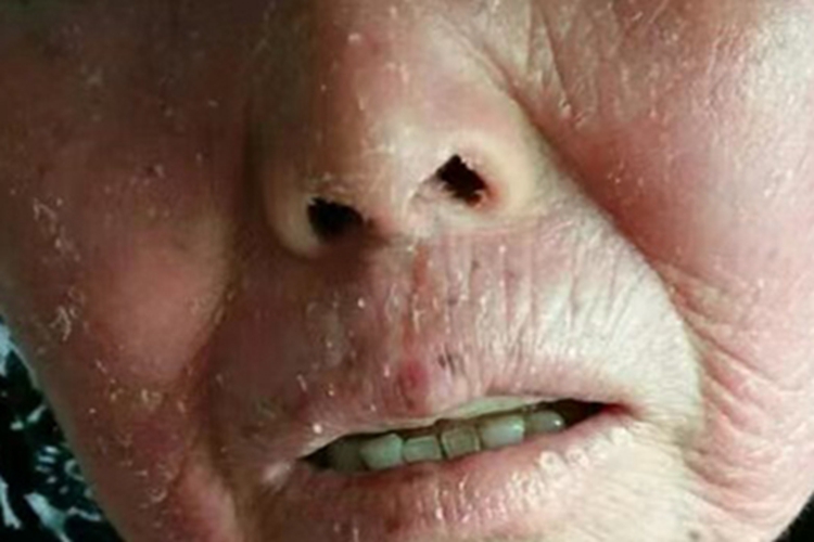 亚急性湿疹面部脱屑图