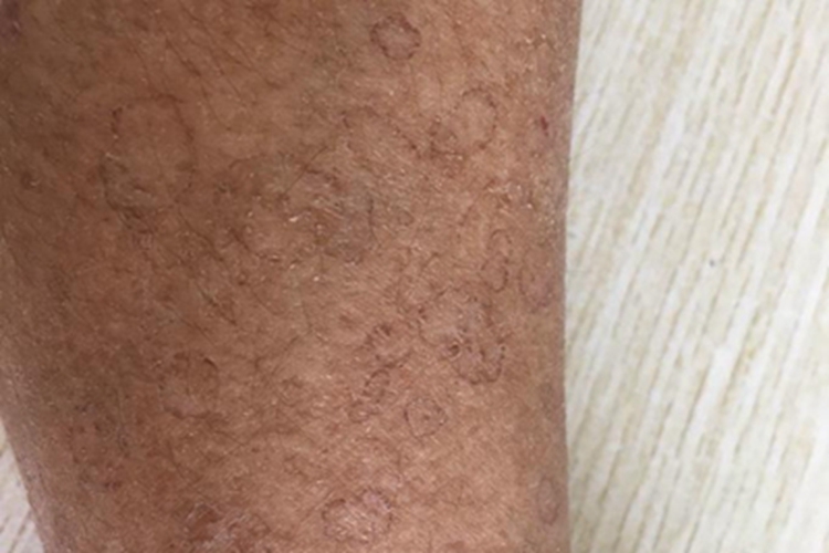 汗孔角化症小腿上长小圆圈斑图