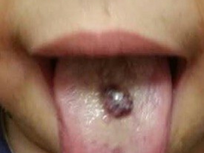 疣状血管瘤舌头上有肿块图.jpg