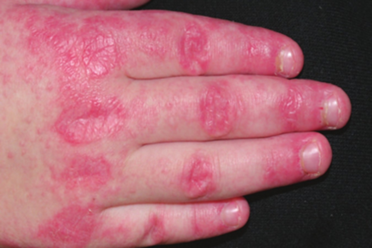 皮肌炎手指皮肤增厚图