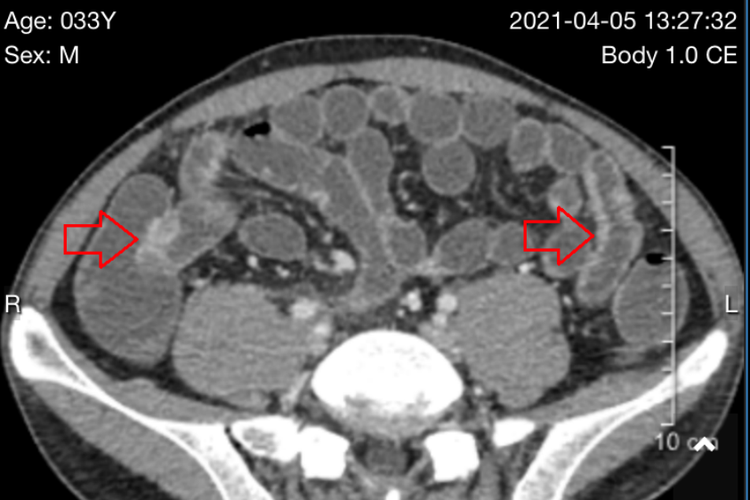 肠道CT检查部位示意图 肠道CT检查部位示意图
