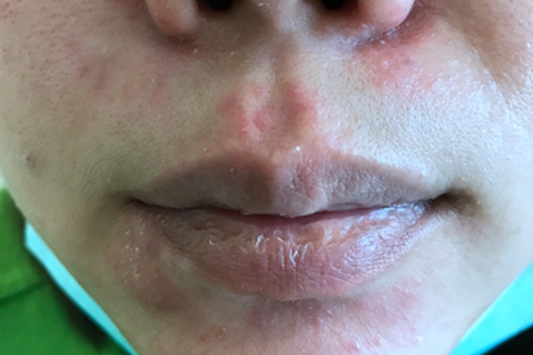 脂溢性皮炎面部小疙瘩图