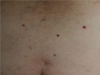 樱桃状血管瘤肚子上长红疙瘩图.png