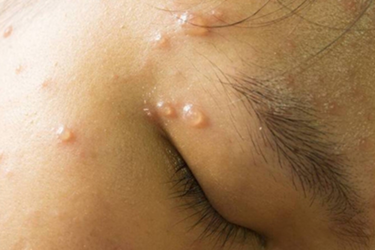 水痘眉毛水疱图