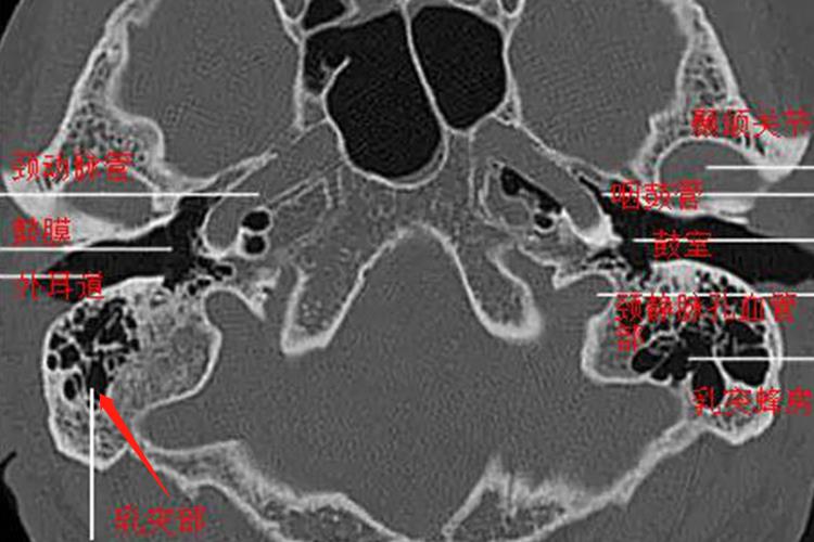 乳突部CT图