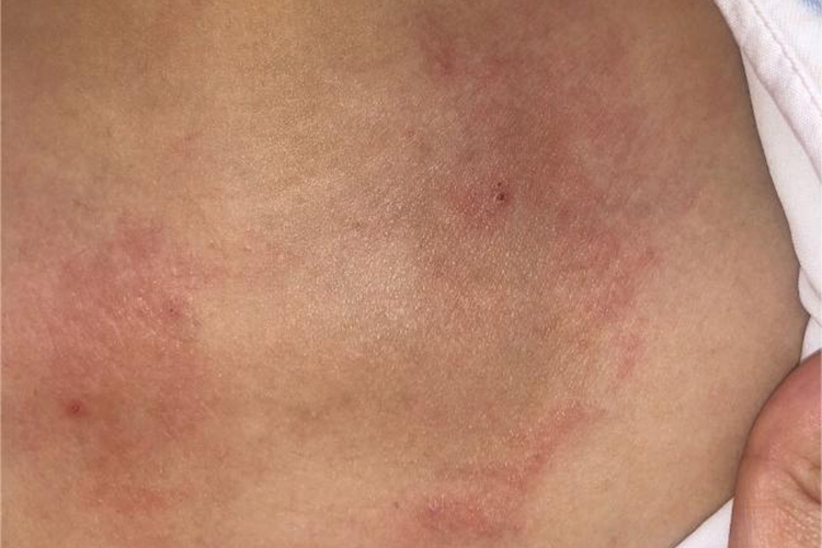 慢性湿疹胸部变粗糙图 慢性湿疹胸部变粗糙图