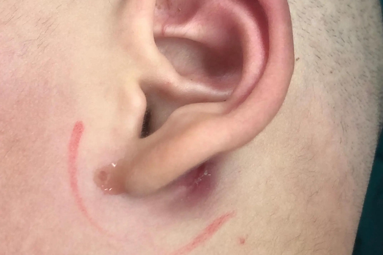 先天性鳃裂瘘管图