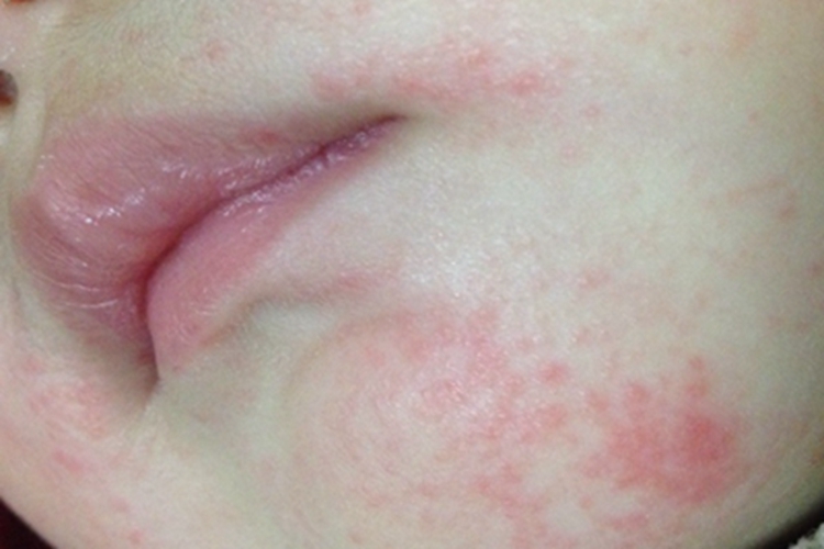 特应性皮炎下巴小红疙瘩图