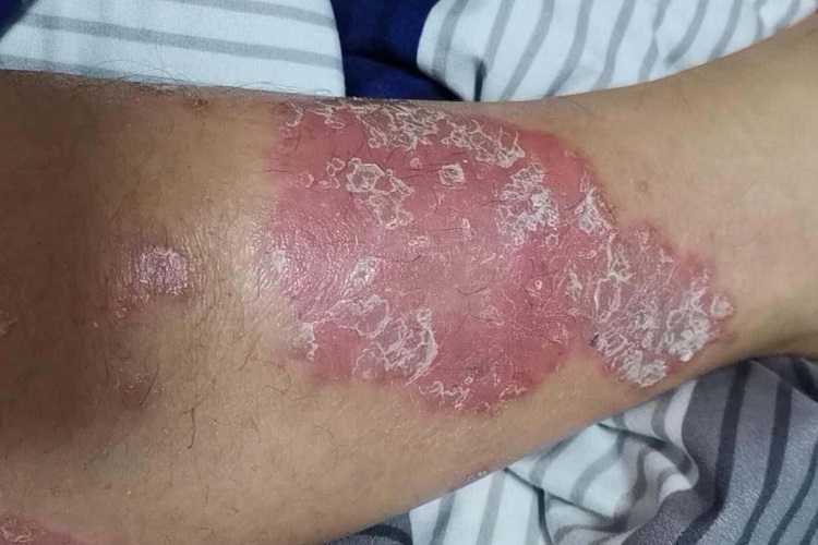 儿童银屑病小腿红斑图