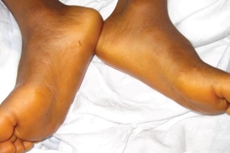 胡萝卜素血症脚部症状图 胡萝卜素血症脚部症状图