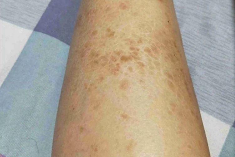 网状肢端色素沉着小腿症状图 网状肢端色素沉着小腿症状图