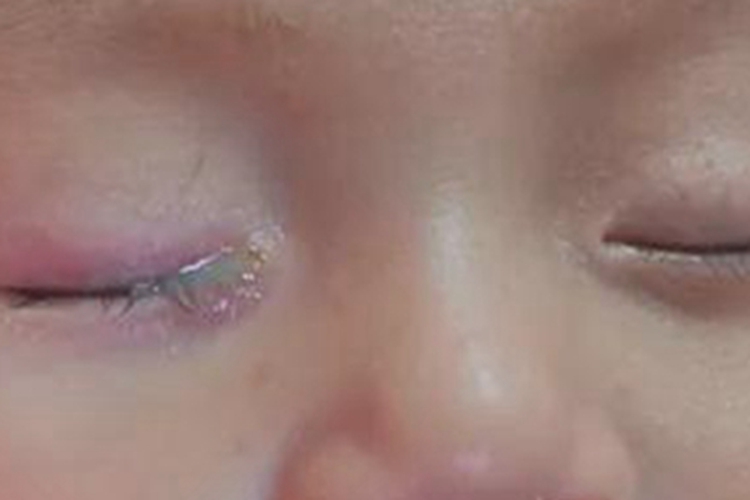 泪腺炎宝宝眼角有脓液流出图