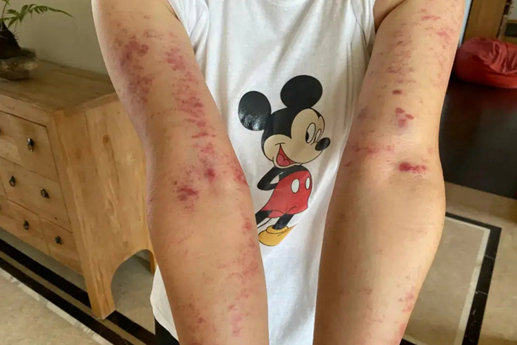 手臂紫癜红色斑片图 手臂紫癜红色斑片图