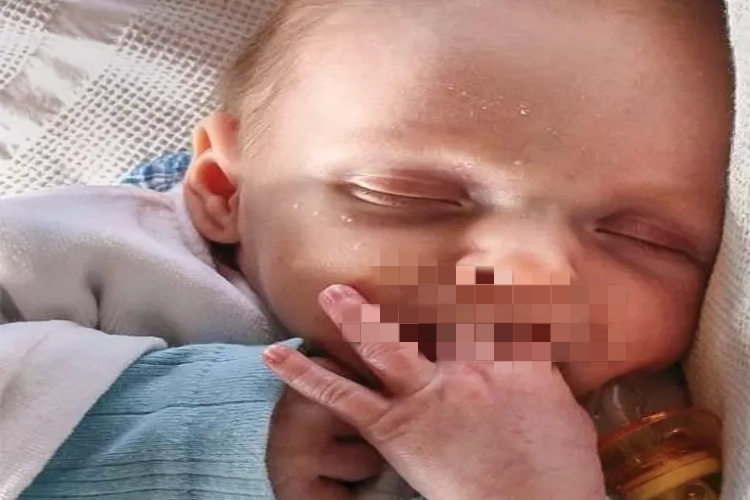 儿童眼窝凹陷严重图