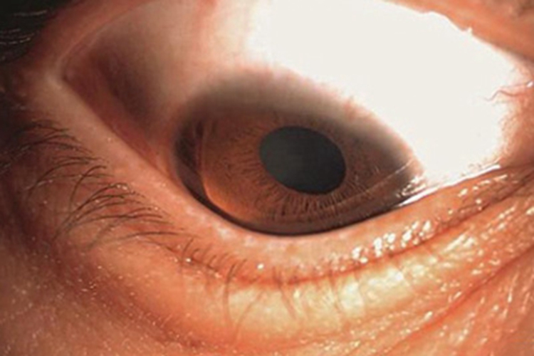 圆锥角膜角膜形状改变图