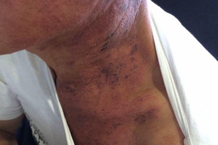 带状疱疹颈部色素沉着图