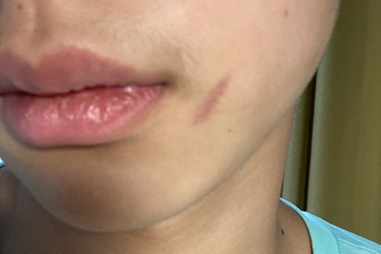 过敏性紫癜面部红斑图