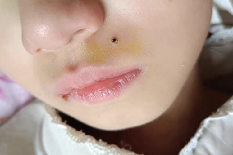 复合痣面部疙瘩图