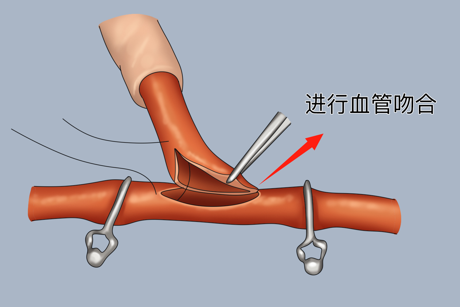 冠状动脉旁路移植术血管吻合图