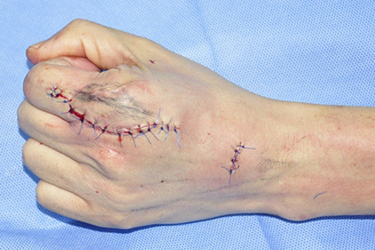 手指肌腱松解术缝合图 手指肌腱松解术缝合图