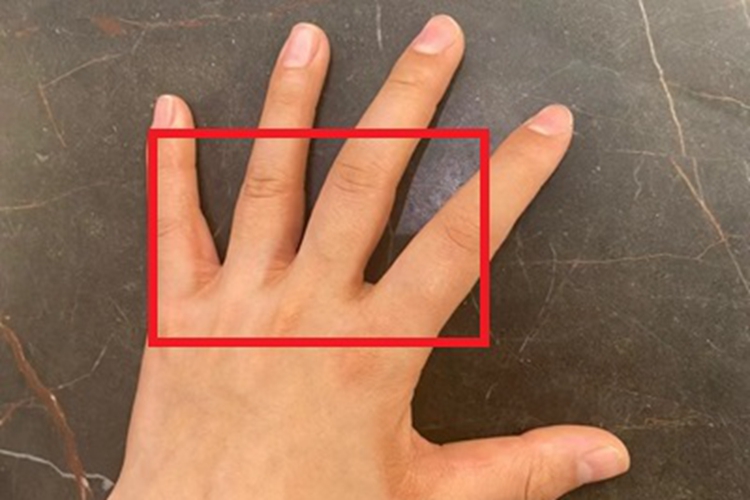 弥漫性掌跖角化病手指缝症状图