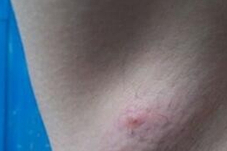 积乳囊肿红肿图