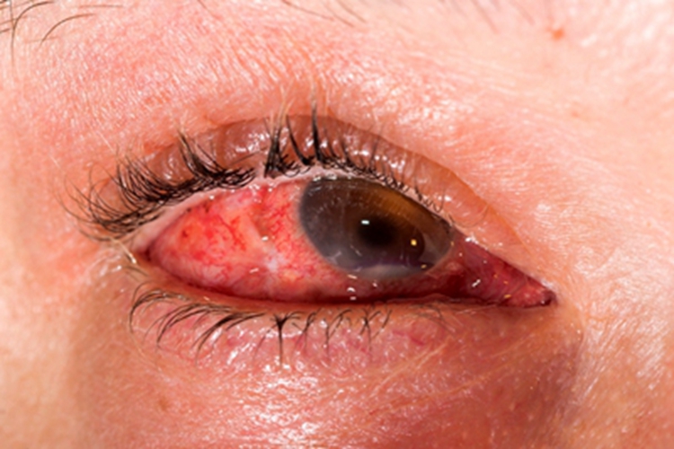 急性卡他性结膜炎眼球红肿图