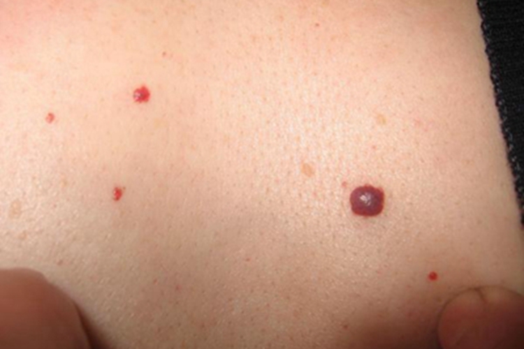 樱桃状血管瘤胸部疙瘩图