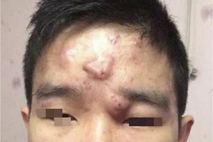 寻常痤疮面部大疙瘩图 寻常痤疮面部大疙瘩图
