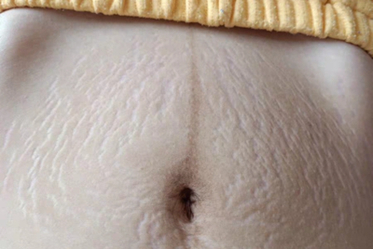 妊娠纹腹部出现白色条纹图 妊娠纹腹部出现白色条纹图