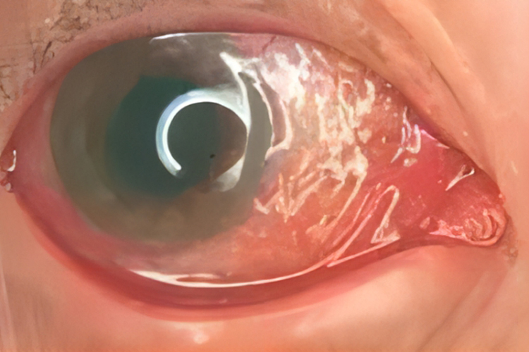 淋菌性结膜炎图