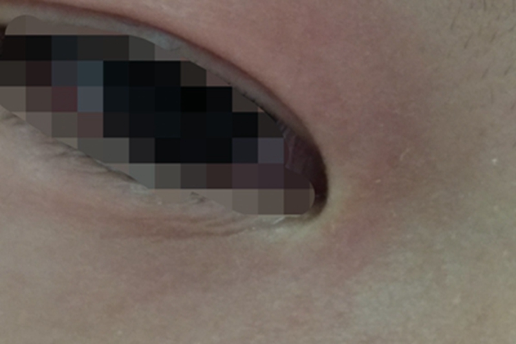 过敏性皮炎眼周症状图 过敏性皮炎眼周症状图