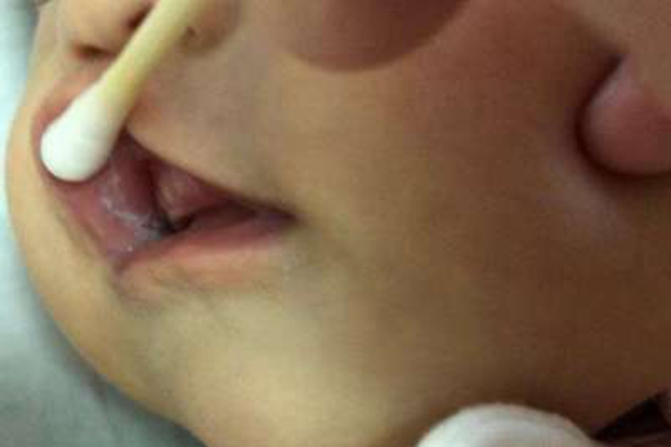 新生儿鹅口疮上唇内有白斑图 新生儿鹅口疮上唇内有白斑图