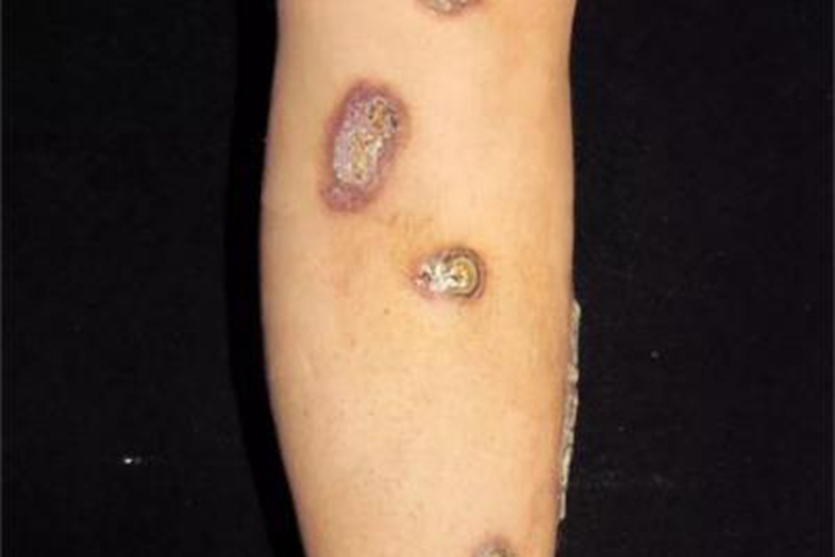 反应性穿通性胶原病腿疙瘩图