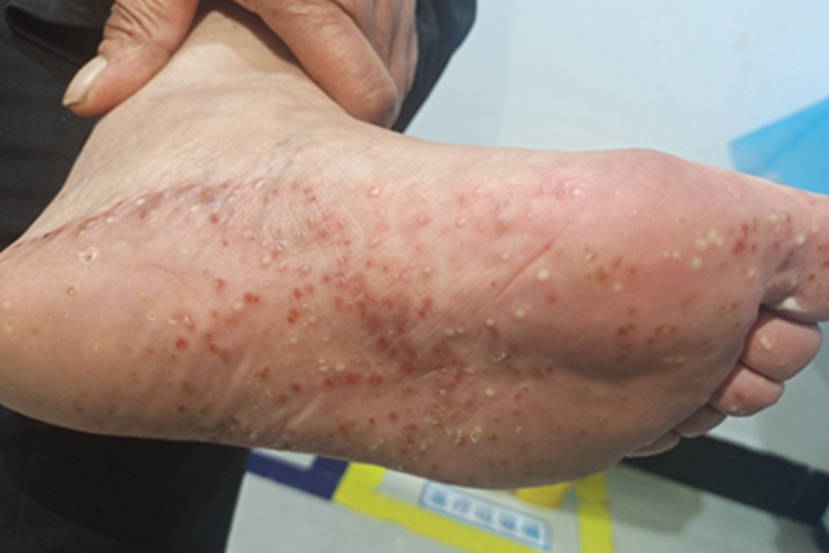 掌跖脓疱病脚底血点图